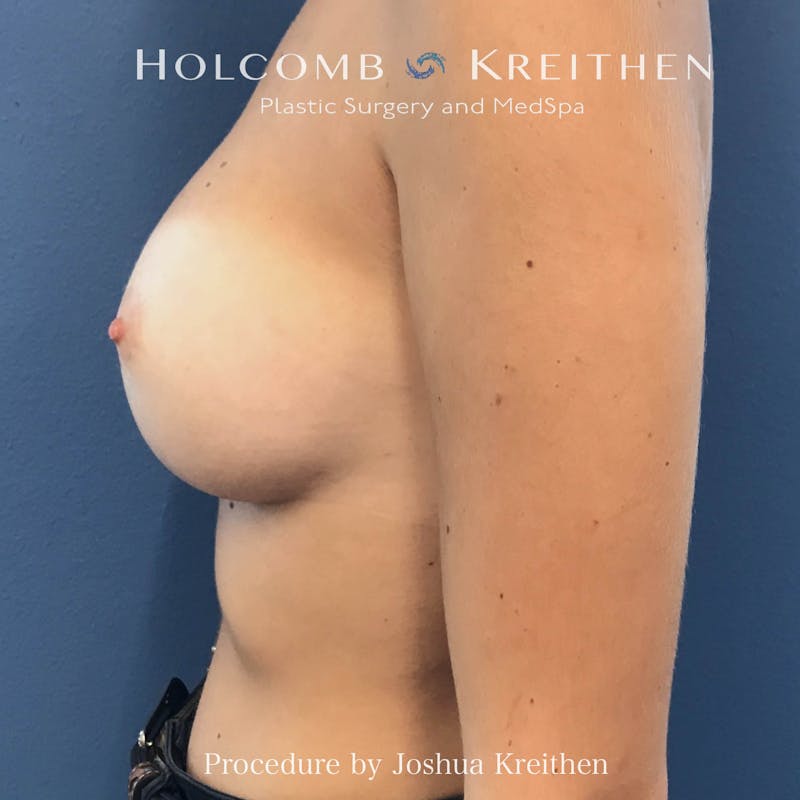 Motiva Breast Implants Before & After Gallery - Patient 883916 - Image 6