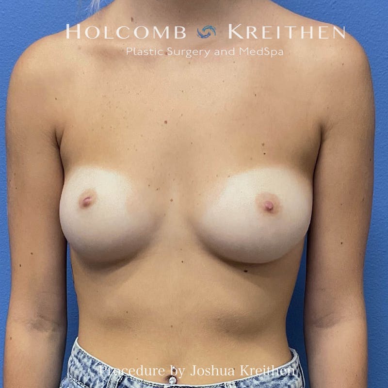 Motiva Breast Implants Before & After Gallery - Patient 883916 - Image 1
