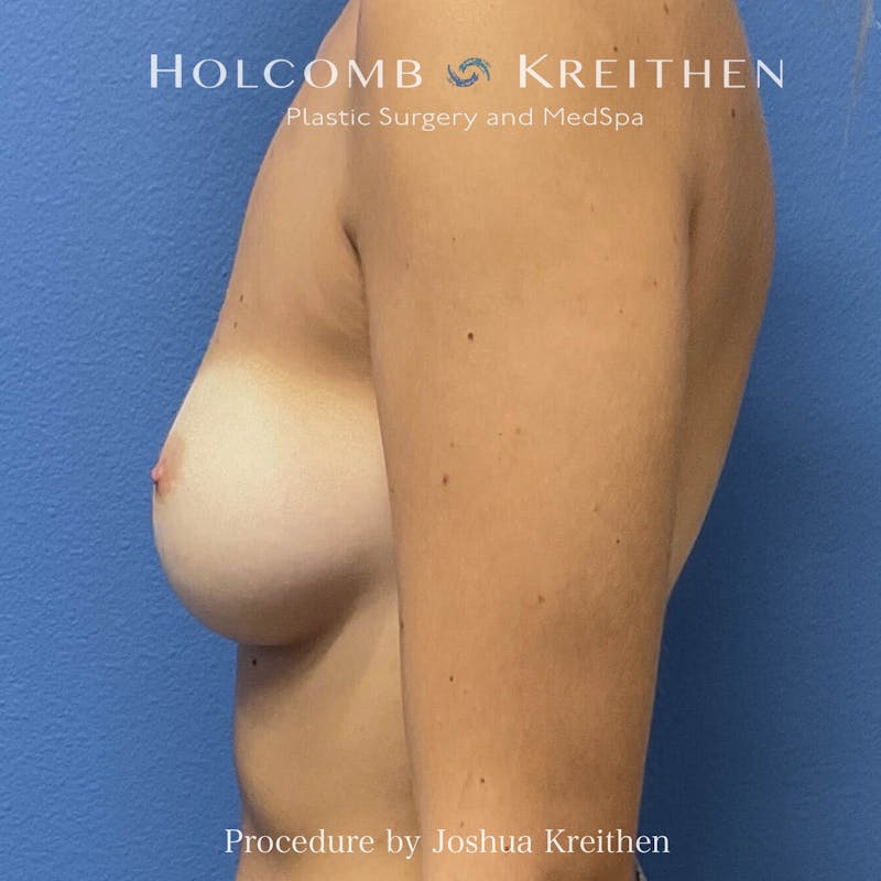 Motiva Breast Implants Before & After Gallery - Patient 883916 - Image 5