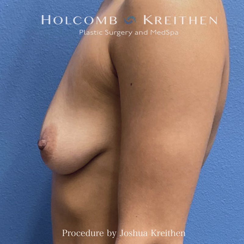 Motiva Breast Implants Before & After Gallery - Patient 330884 - Image 5