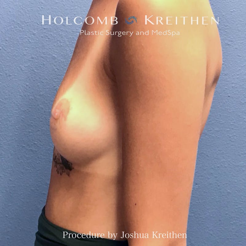 Motiva Breast Implants Before & After Gallery - Patient 727026 - Image 3
