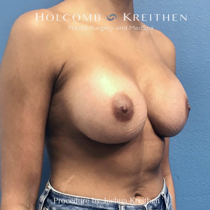 Motiva Breast Implants Before & After Gallery - Patient 184765 - Image 4