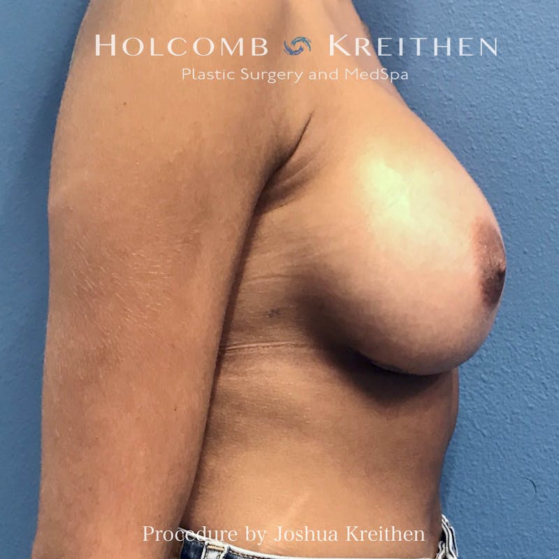 Motiva Breast Implants Before & After Gallery - Patient 184765 - Image 6