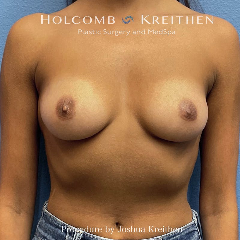 Motiva Breast Implants Before & After Gallery - Patient 184765 - Image 1