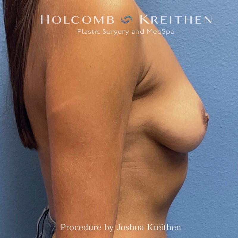 Motiva Breast Implants Before & After Gallery - Patient 184765 - Image 5