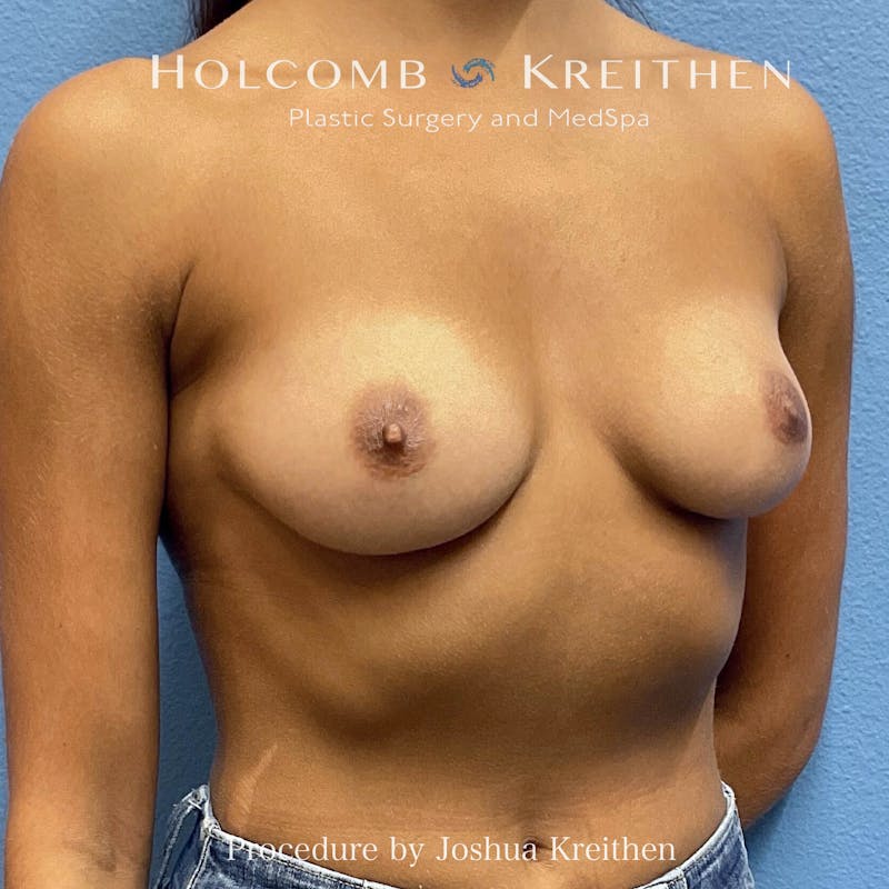 Motiva Breast Implants Before & After Gallery - Patient 184765 - Image 3