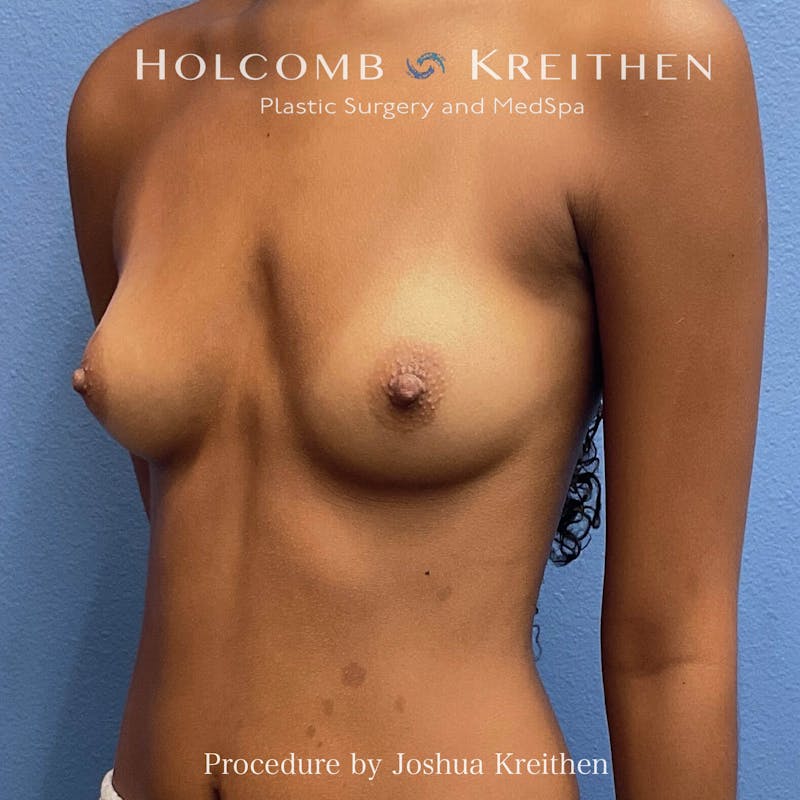 Motiva Breast Implants Before & After Gallery - Patient 362806 - Image 3