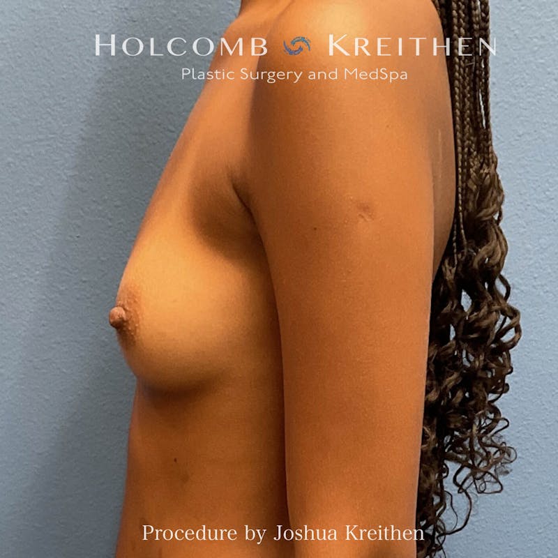 Motiva Breast Implants Before & After Gallery - Patient 362806 - Image 5