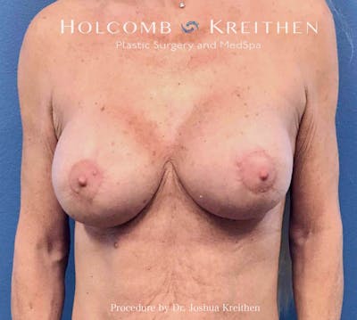 Breast Lift Before & After Gallery - Patient 427013 - Image 2