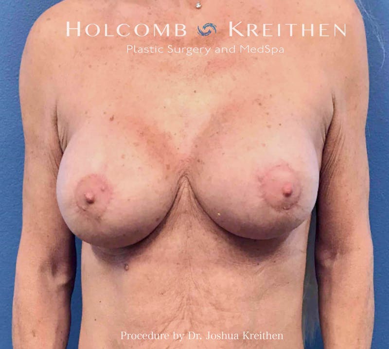 Breast Lift Before & After Gallery - Patient 427013 - Image 2