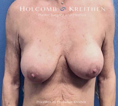 Breast Lift Before & After Gallery - Patient 427013 - Image 1