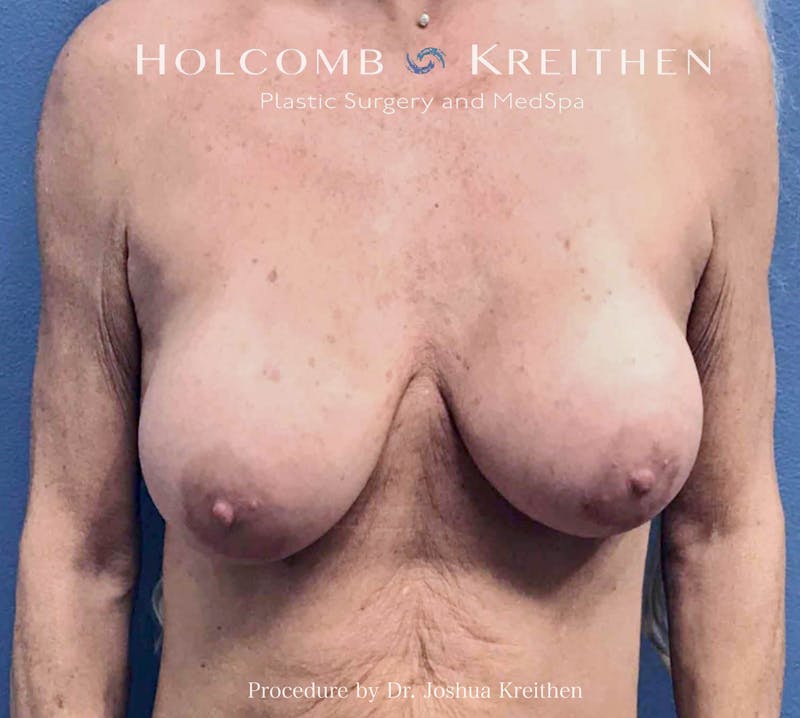 Breast Lift Before & After Gallery - Patient 427013 - Image 1