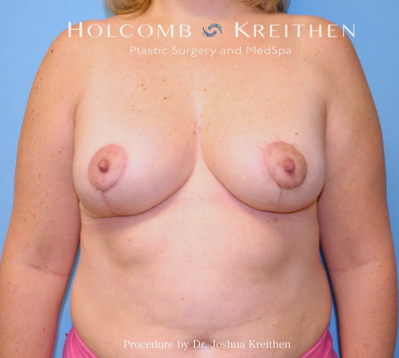 Breast Lift Before & After Gallery - Patient 404623 - Image 2