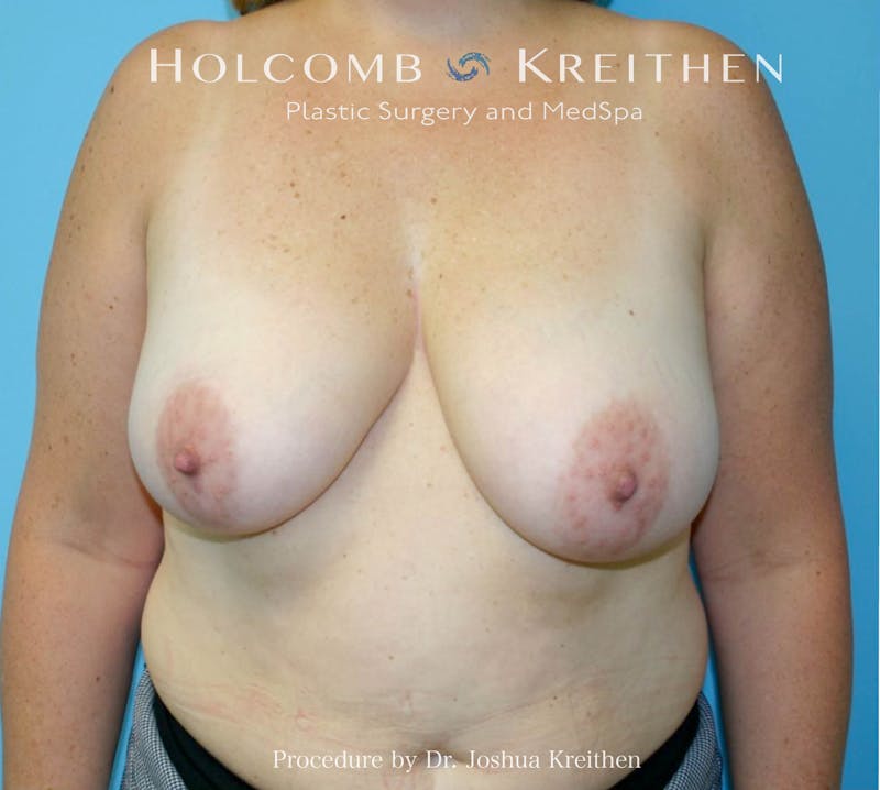 Breast Lift Before & After Gallery - Patient 404623 - Image 1