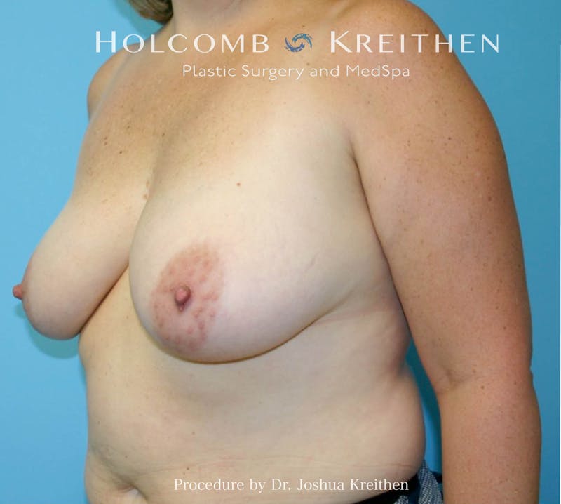 Breast Lift Before & After Gallery - Patient 404623 - Image 5