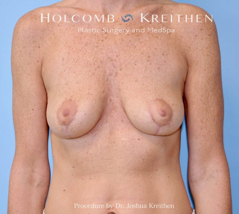 Breast Lift Before & After Gallery - Patient 331050 - Image 2