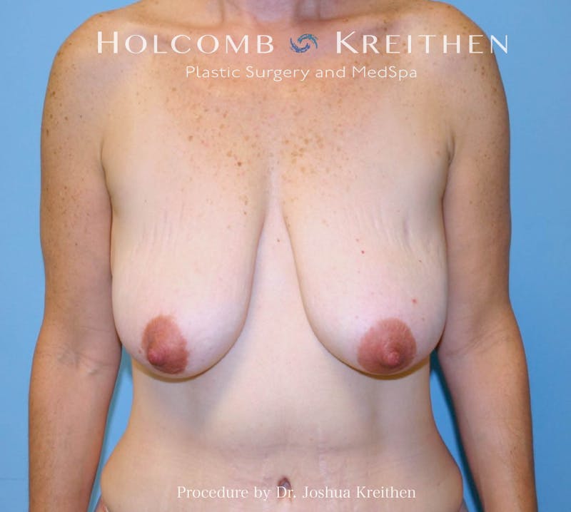 Breast Lift Before & After Gallery - Patient 154511 - Image 1