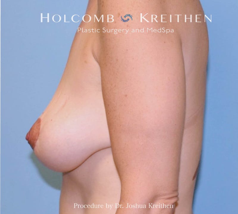 Breast Lift Before & After Gallery - Patient 154511 - Image 4