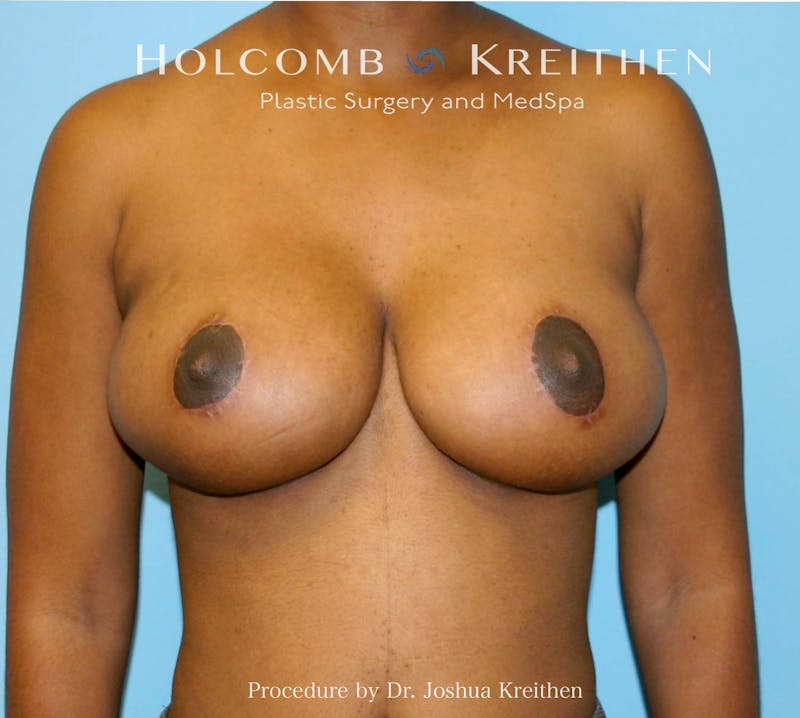 Breast Lift Before & After Gallery - Patient 404725 - Image 2