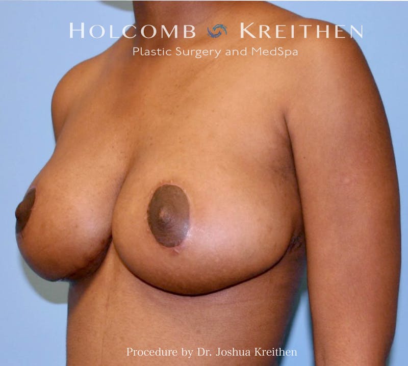 Breast Lift Before & After Gallery - Patient 404725 - Image 4
