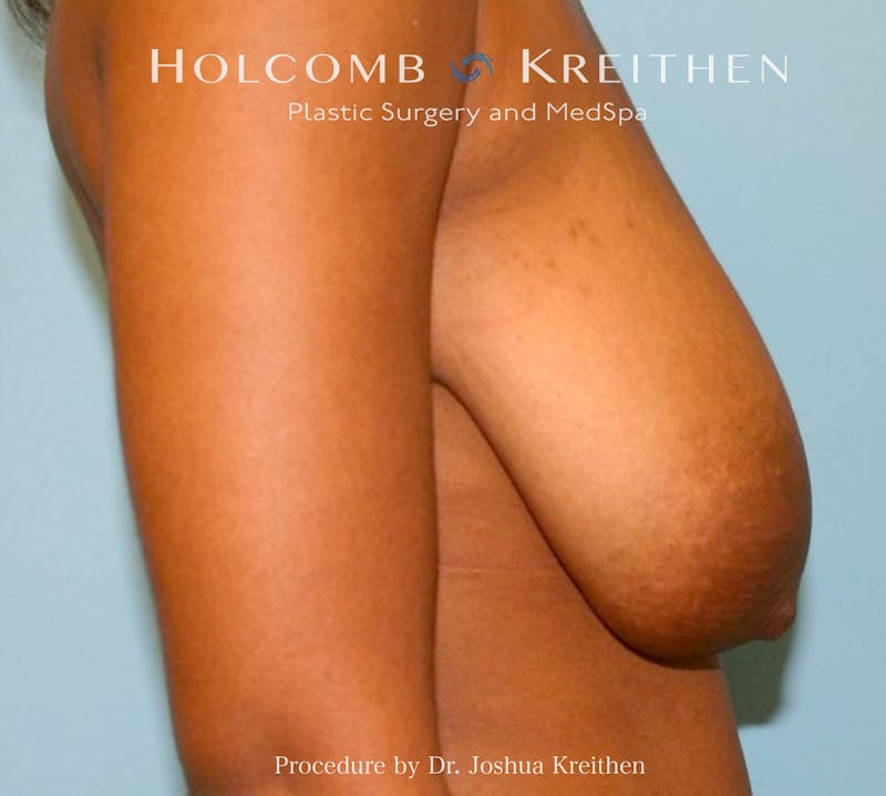 Breast Lift Before & After Gallery - Patient 404725 - Image 5