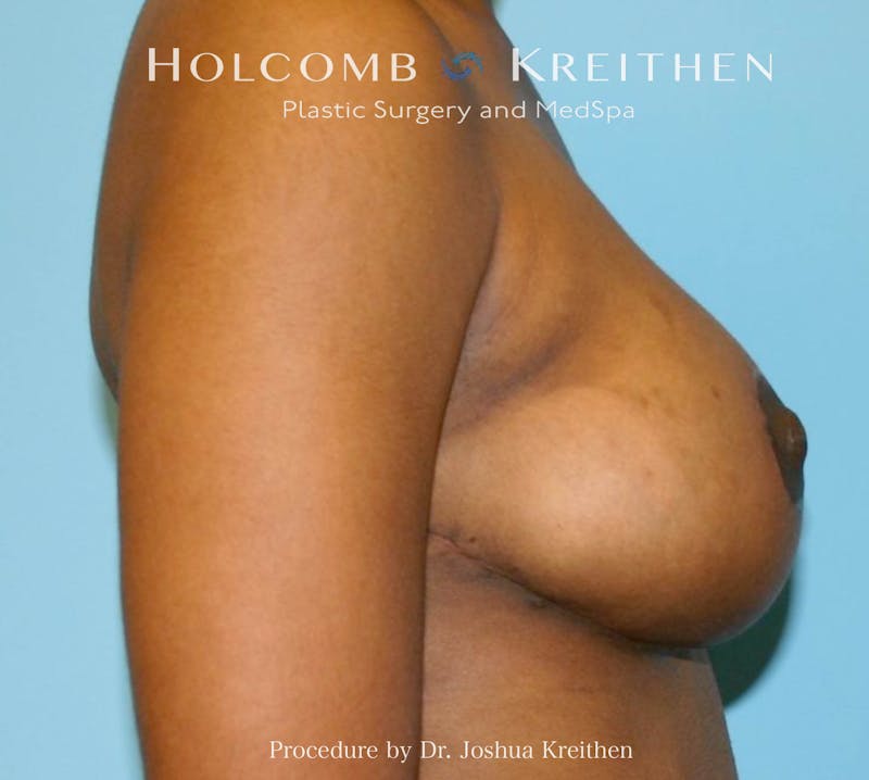 Breast Lift Before & After Gallery - Patient 404725 - Image 6
