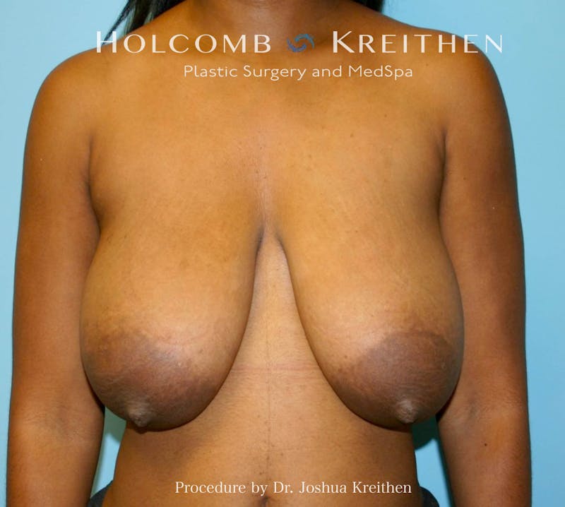 Breast Lift Before & After Gallery - Patient 404725 - Image 1