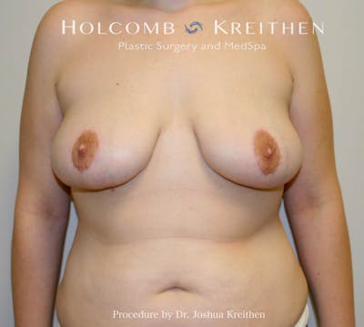Breast Lift Before & After Gallery - Patient 112600 - Image 2