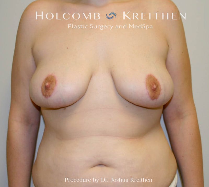 Breast Lift Before & After Gallery - Patient 112600 - Image 2