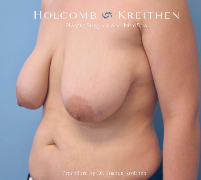 Breast Lift Before & After Gallery - Patient 112600 - Image 3