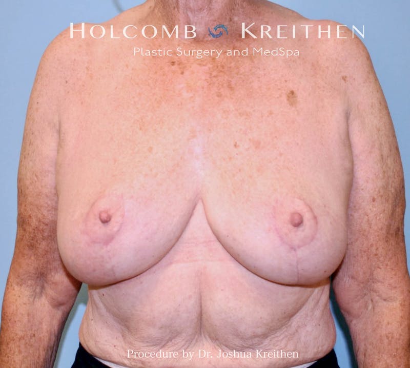 Breast Reduction Before & After Gallery - Patient 250627 - Image 2
