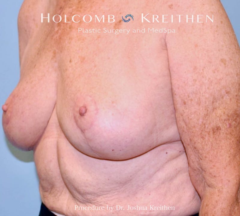 Breast Reduction Before & After Gallery - Patient 250627 - Image 4