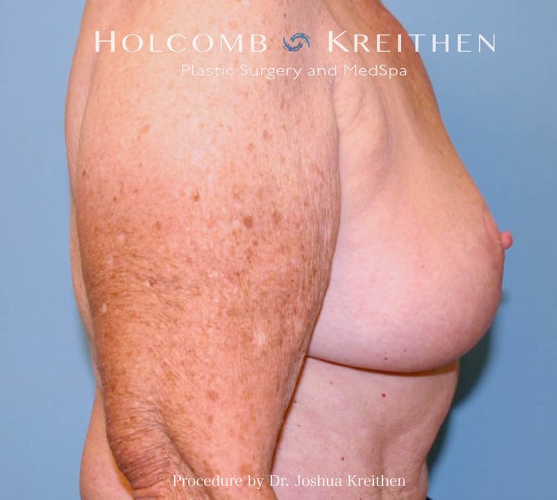 Breast Reduction Before & After Gallery - Patient 250627 - Image 6