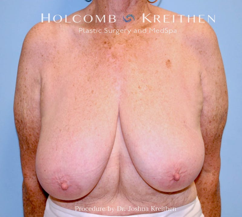 Breast Reduction Before & After Gallery - Patient 250627 - Image 1