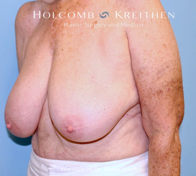 Breast Reduction Before & After Gallery - Patient 250627 - Image 3