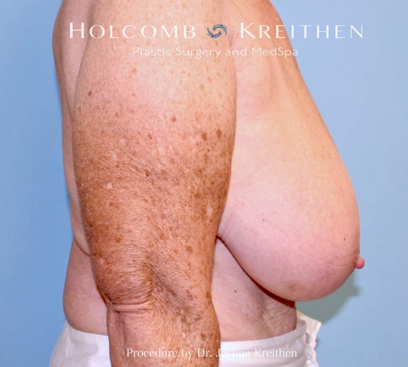 Breast Reduction Before & After Gallery - Patient 250627 - Image 5