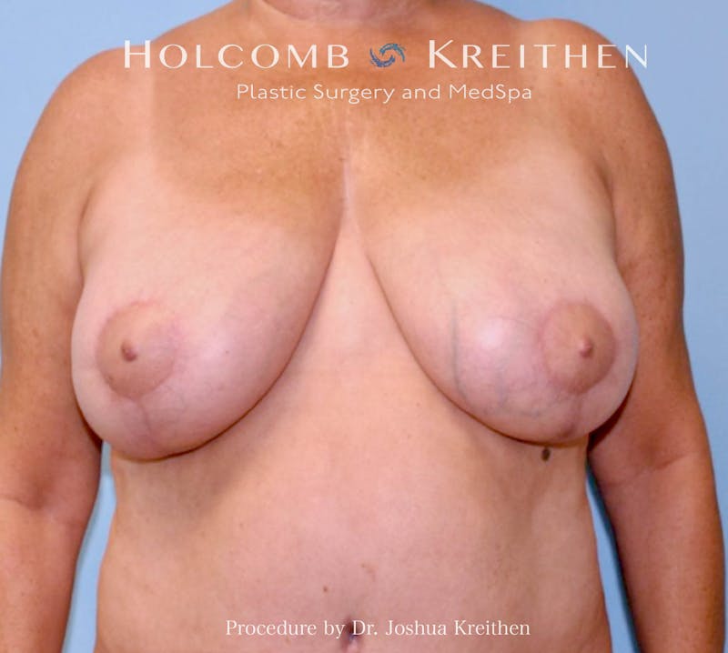Breast Reduction Before & After Gallery - Patient 418659 - Image 2
