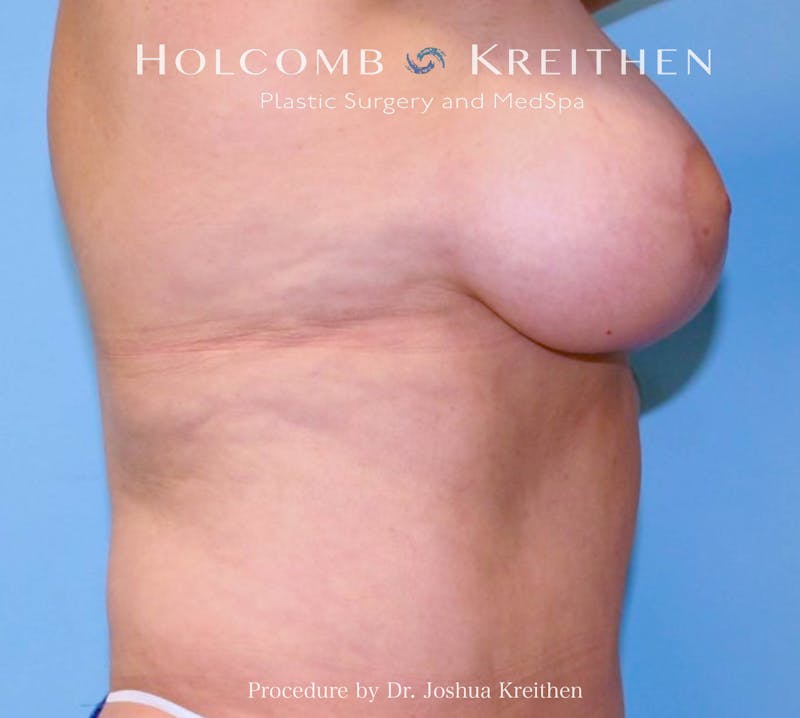 Breast Reduction Before & After Gallery - Patient 418659 - Image 4