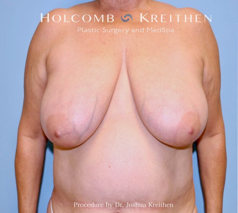 Breast Reduction Before & After Gallery - Patient 418659 - Image 1