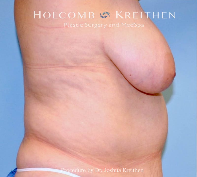 Breast Reduction Before & After Gallery - Patient 418659 - Image 3