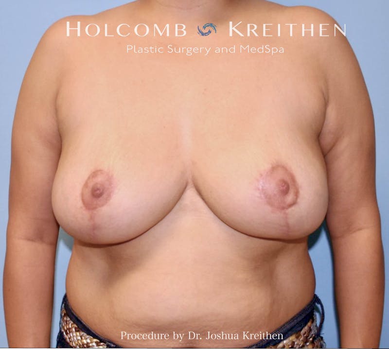 Breast Lift Before & After Gallery - Patient 123428 - Image 2
