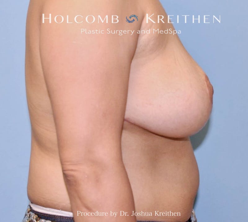 Breast Lift Before & After Gallery - Patient 123428 - Image 6