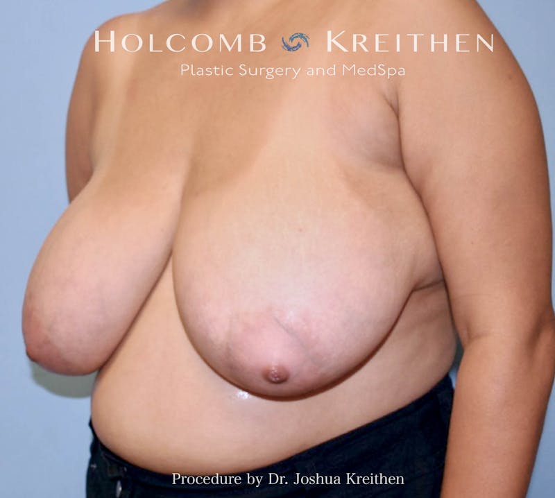Breast Lift Before & After Gallery - Patient 123428 - Image 3