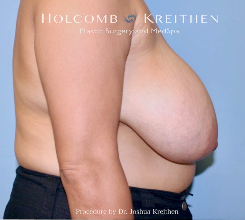 Breast Lift Before & After Gallery - Patient 123428 - Image 5