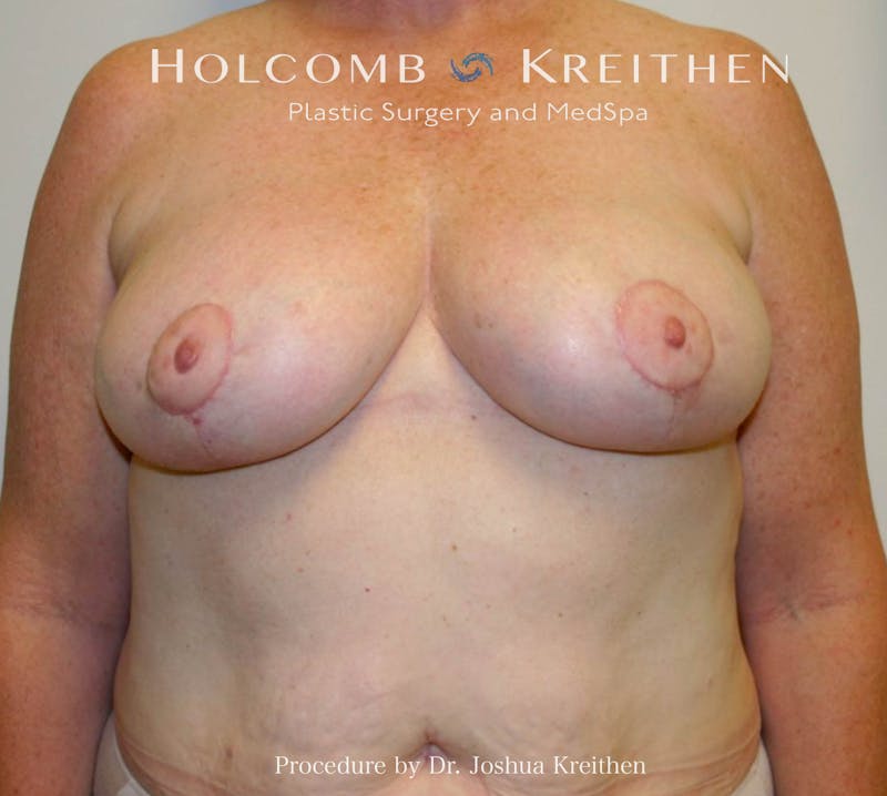 Breast Reduction Before & After Gallery - Patient 405769 - Image 2