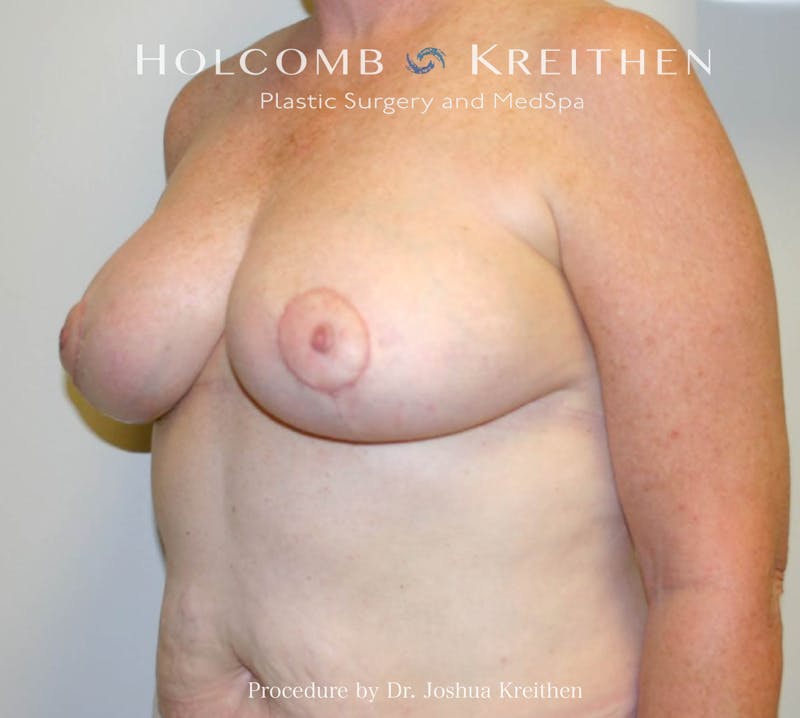 Breast Reduction Before & After Gallery - Patient 405769 - Image 4