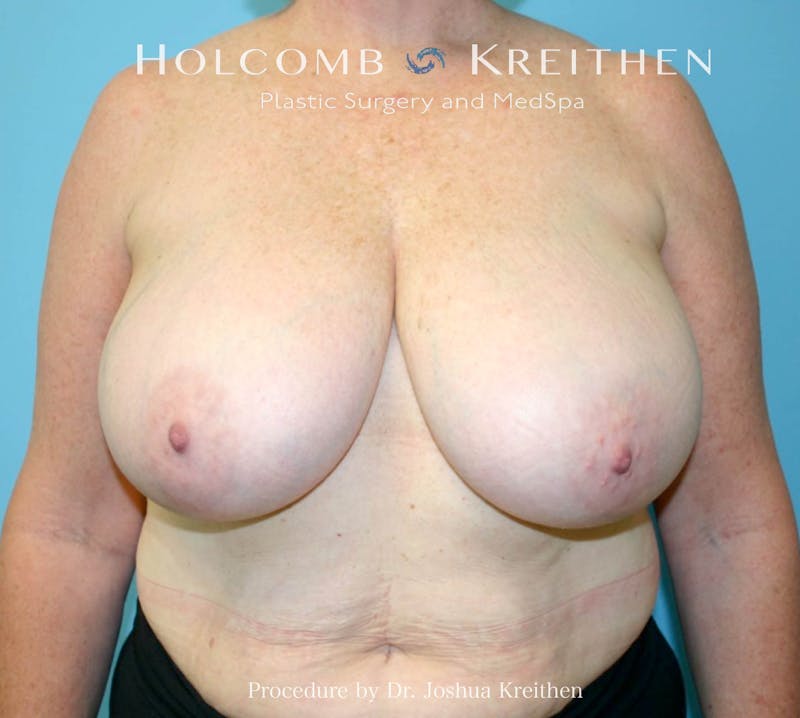 Breast Reduction Before & After Gallery - Patient 405769 - Image 1