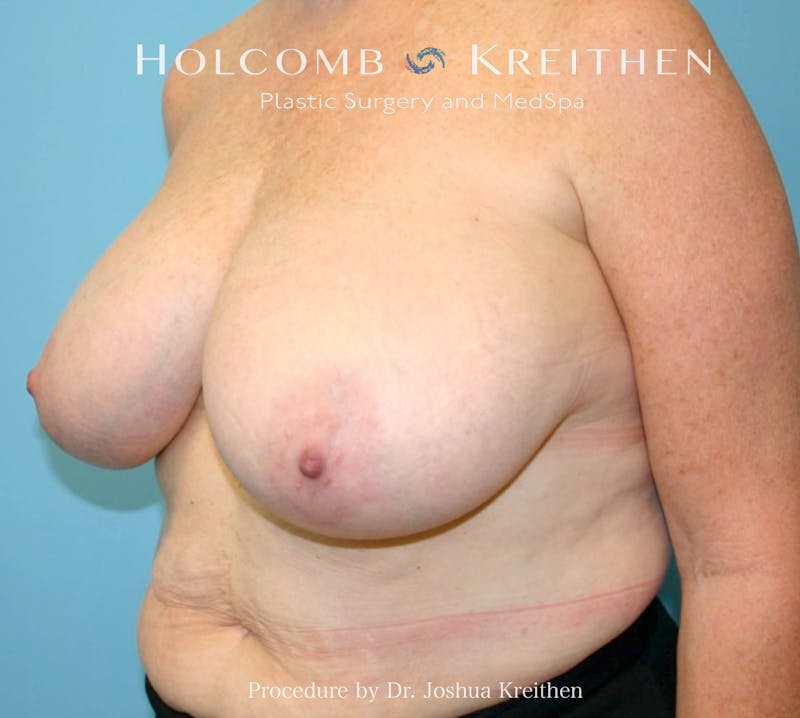 Breast Reduction Before & After Gallery - Patient 405769 - Image 3
