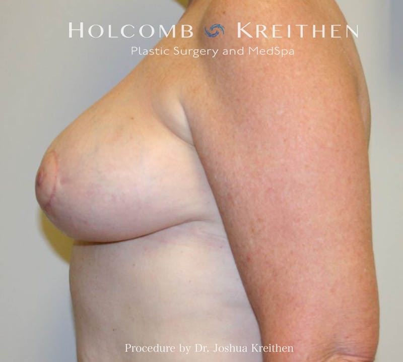 Breast Reduction Before & After Gallery - Patient 405769 - Image 6