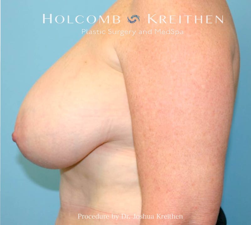 Breast Reduction Before & After Gallery - Patient 405769 - Image 5